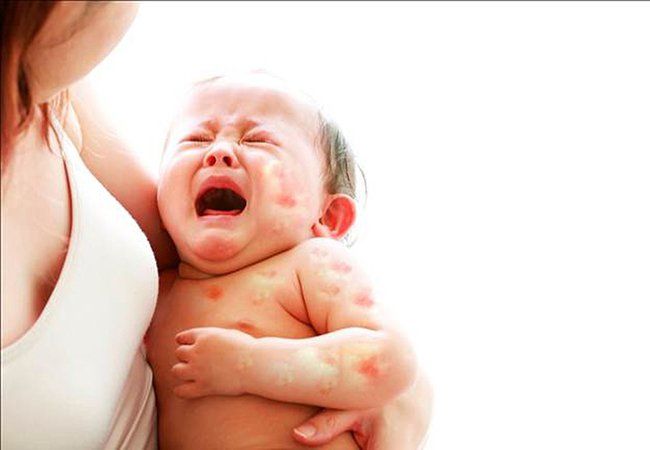 Dị ứng đạm sữa bò