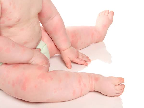 Dị ứng với thực phẩm mới