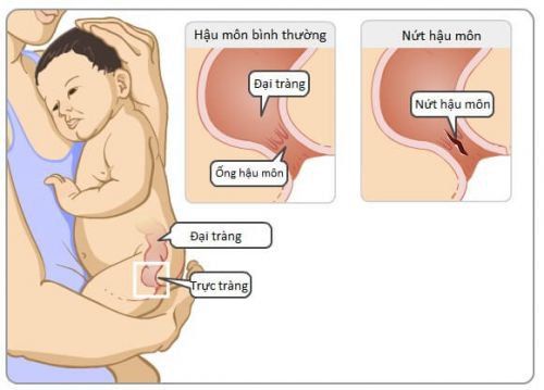 Táo bón gây nứt hậu môn