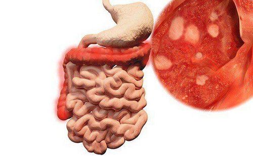 Tổn thương niêm mạc ruột