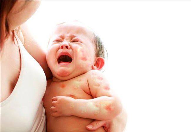 Trẻ bị dị ứng đạm sữa bò