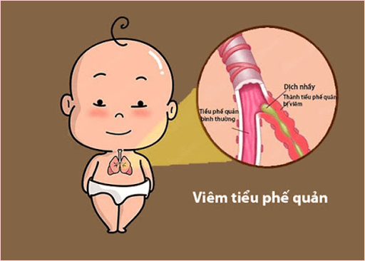 Bệnh viêm phế quản ở trẻ là gì?