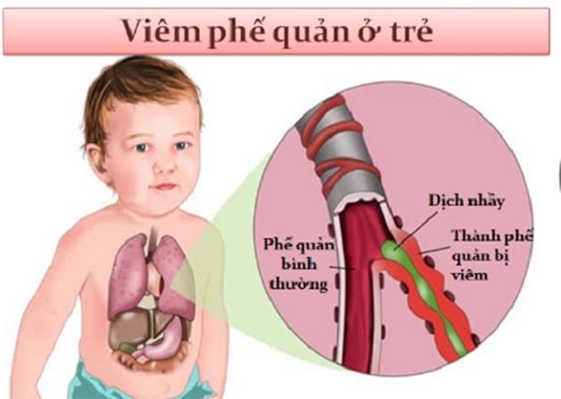 Một số lí do khiến bé mắc viêm phế quản
