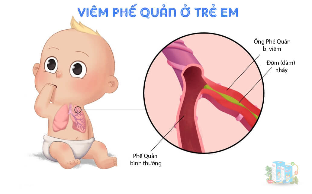 Nhiều đờm ở trẻ là dấu hiệu của bệnh viêm phế quản