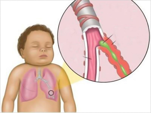 Bệnh viêm phế quản ở trẻ