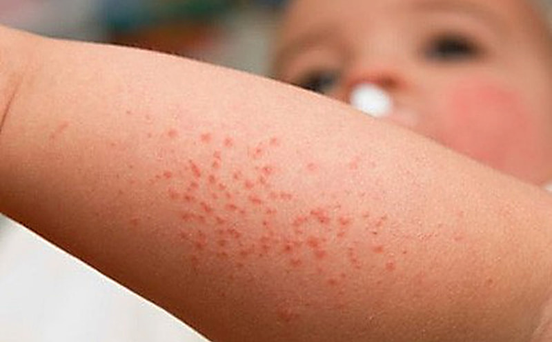 sốt xuất huyết ở trẻ em