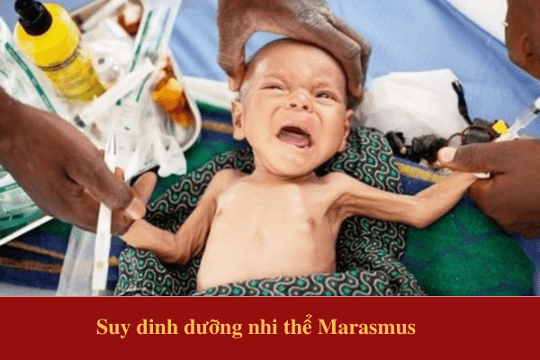 Suy dinh dưỡng nhi thể Marasmus