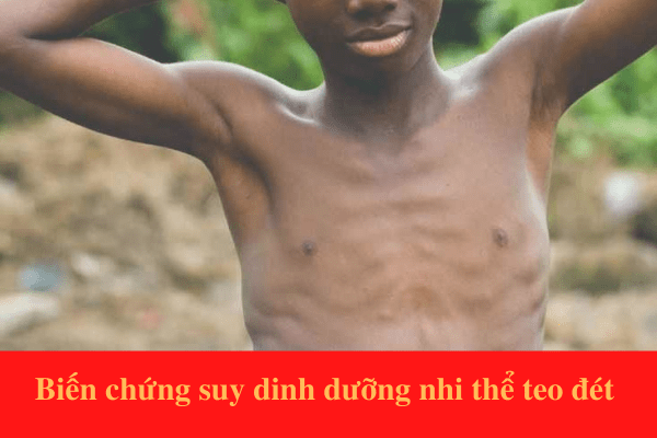 Biến chứng của suy dinh dưỡng nhi thể teo đét Marasmus