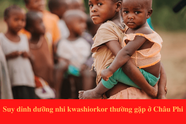 Suy dinh dưỡng nhi Kwashiorkor phổ biến ở các nước đang phát triển ở Châu Phi