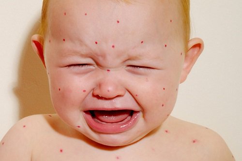 Trẻ em là đối tượng dễ mắc sởi