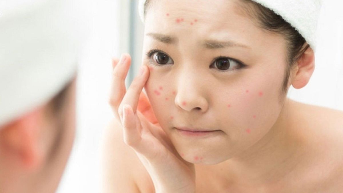 trẻ nổi nhiều mụn ở tuổi dậy thì