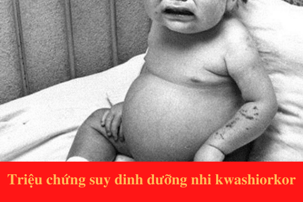 Triệu chứng điển hình của suy dinh dưỡng nhi thể phù Kwashiorkor