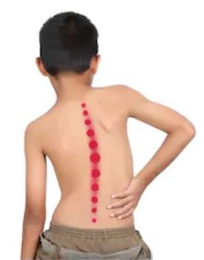 cong vẹo cột sống ở trẻ