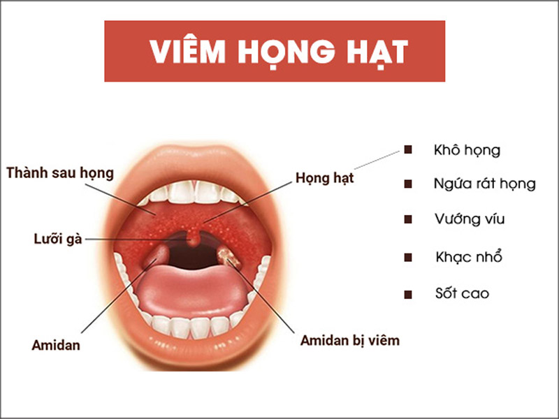bac si nhi - viem hong hat