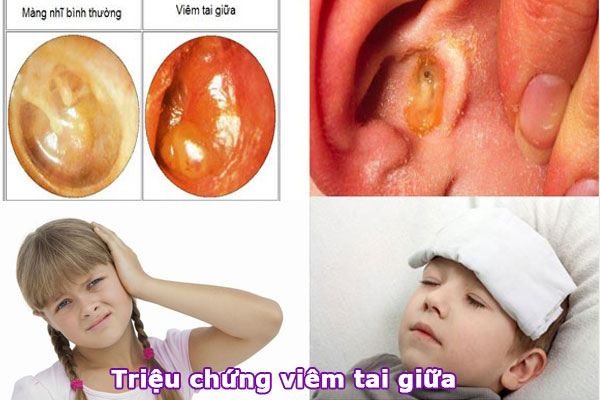 khám bệnh lý nhi viêm tai giữa