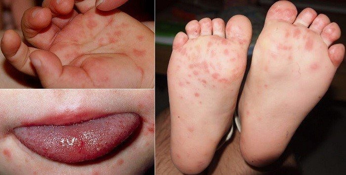 Nổi mụn nước ở tay, chân và miệng