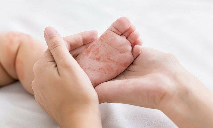 Phân biệt dị ứng đạm sữa bò và bất dung nạp lactose ở trẻ