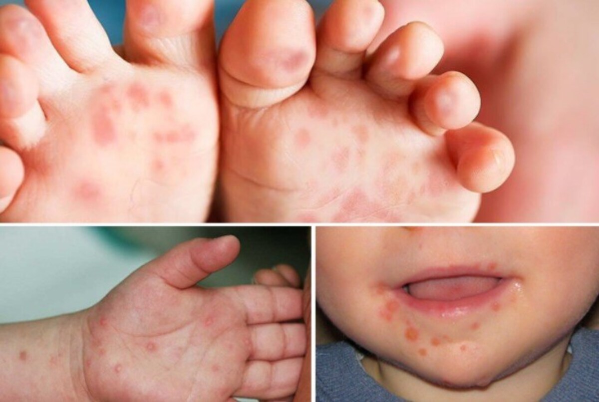bệnh tay chân miệng ở trẻ